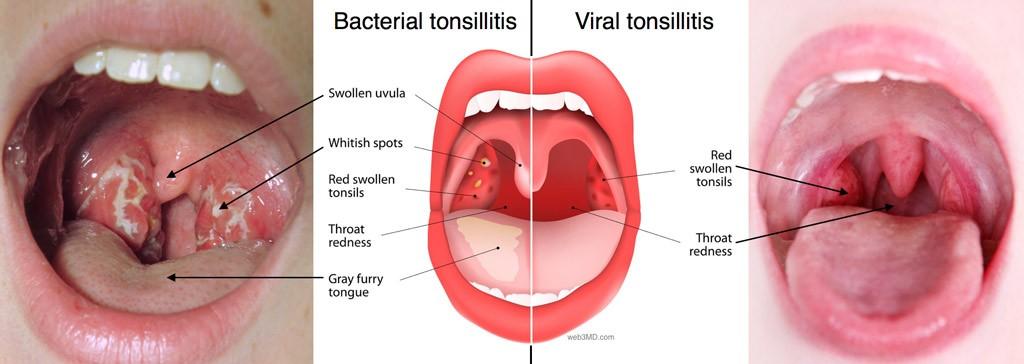 Tonsillectomy/Adenoidectomy