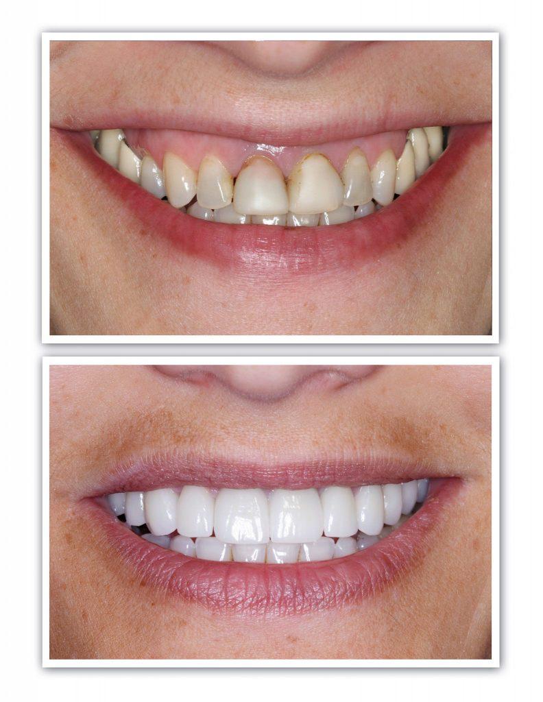 Dental Implant – Nilecare Dental Hospital